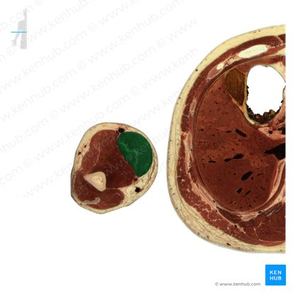 Biceps brachii muscle (Musculus biceps brachii); Image: National Library of Medicine