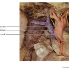 Clinical case: Pulmonary embolism