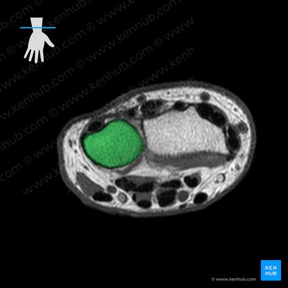 Ulna (Elle); Bild: 