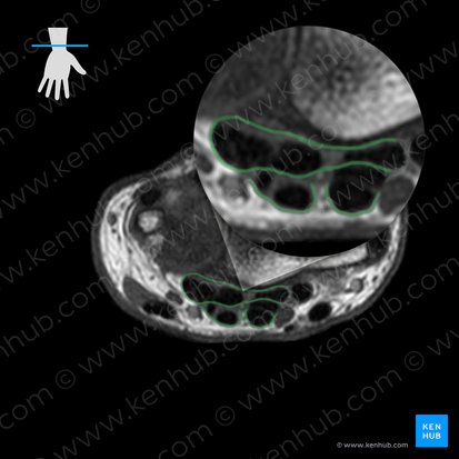 Common flexor sheath of hand (Vagina communis tendinum musculorum flexorum); Image: 