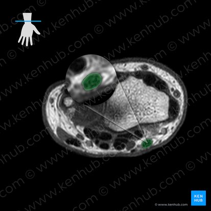 Tendon of flexor carpi radialis muscle (Tendo musculi flexoris carpi radialis); Image: 