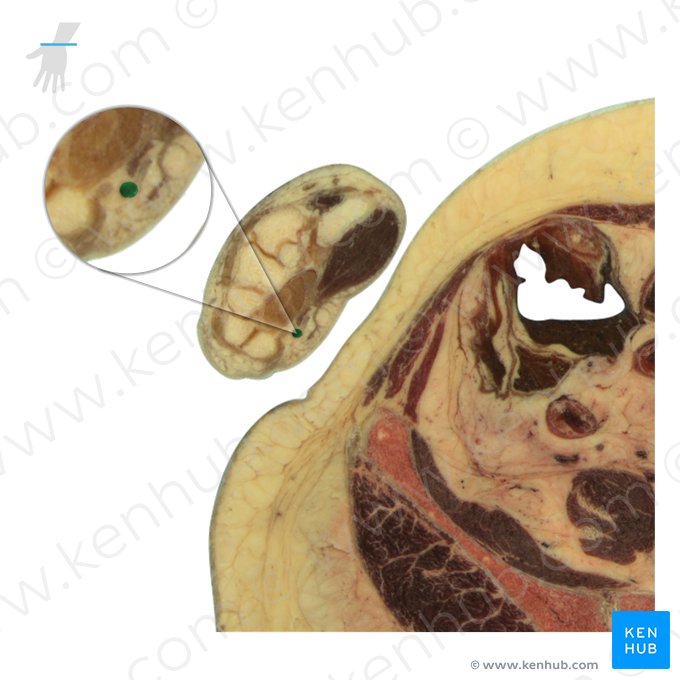 Arteria ulnaris (Ellenarterie); Bild: National Library of Medicine
