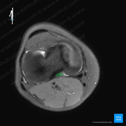 Posterior cruciate ligament (Ligamentum cruciatum posterius); Image: 