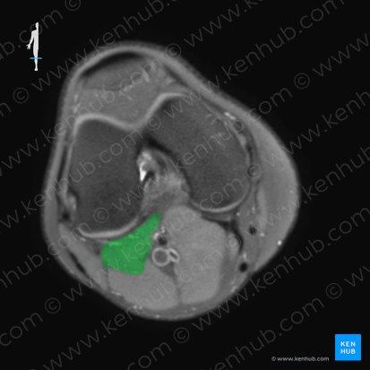 Musculus plantaris (Fußsohlenmuskel); Bild: 