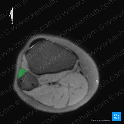 Musculus fibularis longus (Langer Wadenbeinmuskel); Bild: 