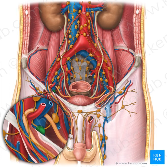 Linfonodo lacunar medial (Nodus lymphoideus lacunaris medialis); Imagem: Esther Gollan