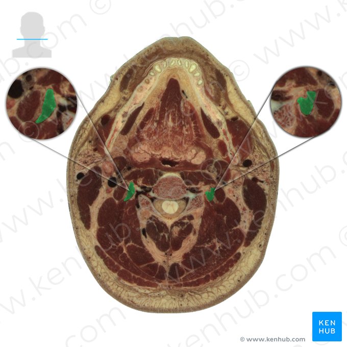 Músculo longuíssimo do pescoço (Musculus longissimus cervicis); Imagem: National Library of Medicine