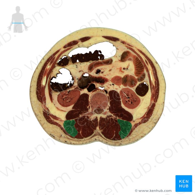 Músculo iliocostal lombar (Musculus iliocostalis lumborum); Imagem: National Library of Medicine