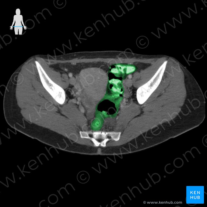 Colon sigmoideo (Colon sigmoideum); Imagen: 