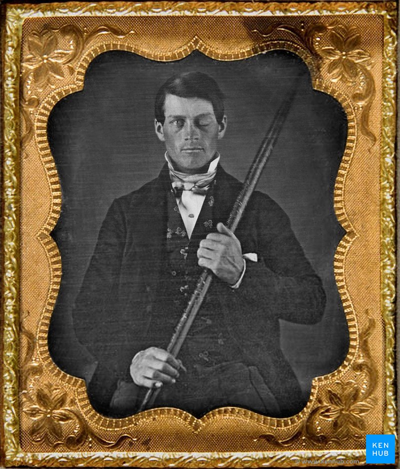 Phineas Gage - Lesión de la corteza prefrontal