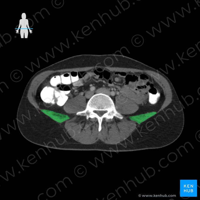 Musculus quadratus lumborum (Viereckiger Lendenmuskel); Bild: 