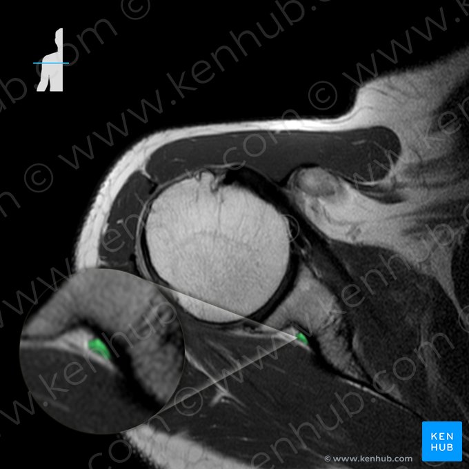 Suprascapular nerve (Nervus suprascapularis); Image: 