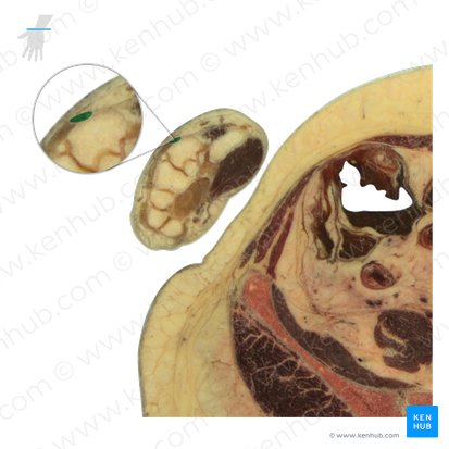 Tendão do músculo extensor radial curto do carpo (Tendo musculi extensor carpi radialis brevis); Imagem: National Library of Medicine