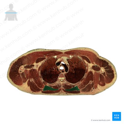 Músculo romboides mayor (Musculus rhomboideus major); Imagen: National Library of Medicine