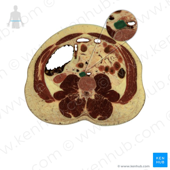 Veia cava inferior (Vena cava inferior); Imagem: National Library of Medicine