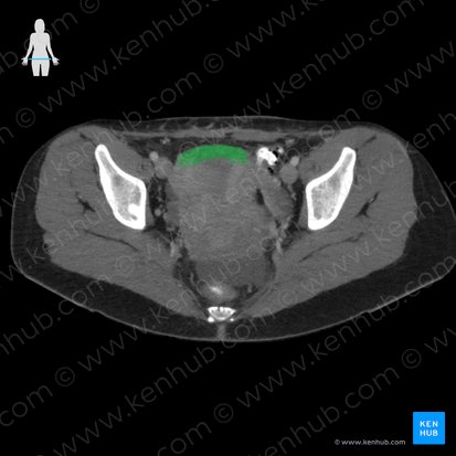 Fundus uteri (Fundus der Gebärmutter); Bild: 