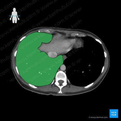 Right lung (Pulmo dexter); Image: 