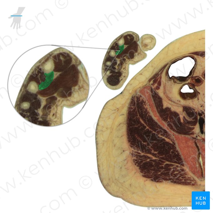 1st palmar interosseous muscle (Musculus interosseus palmaris 1); Image: National Library of Medicine