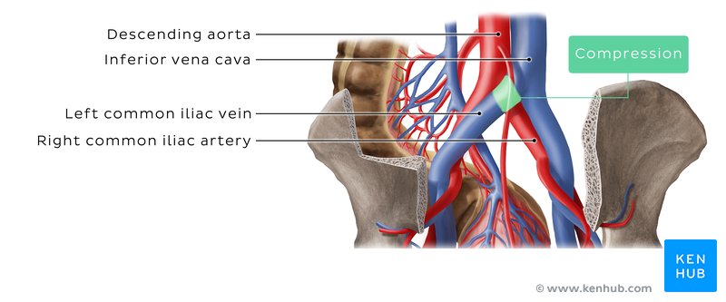 Left Common Iliac Vein Compression