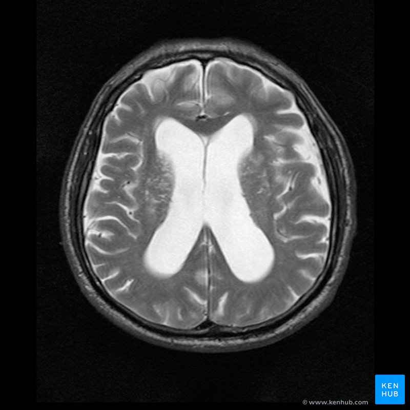 Enlarged lateral ventricles - T2 MRI