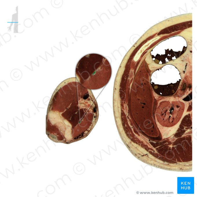 Nervo mediano (Nervus medianus); Imagem: National Library of Medicine