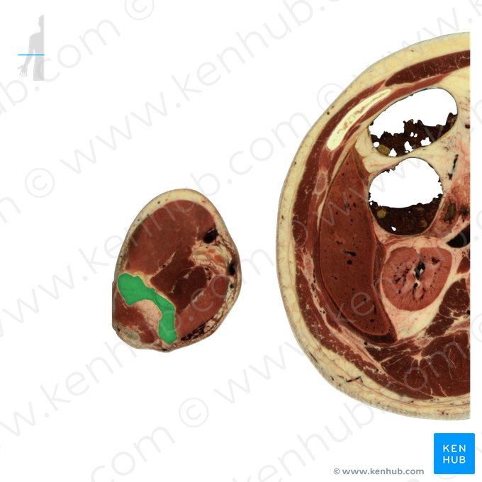 Úmero (Humerus); Imagem: National Library of Medicine