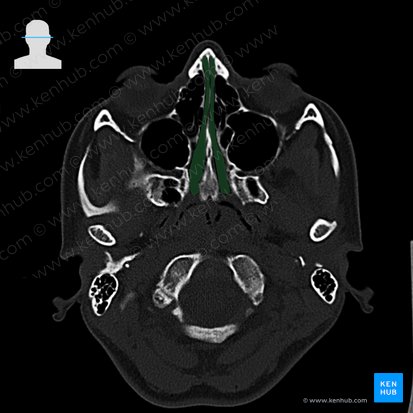 Meato nasal común (Meatus nasalis communis); Imagen: 