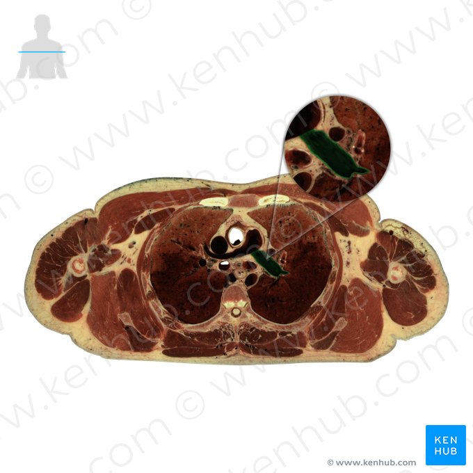 Left pulmonary artery (Arteria pulmonalis sinistra); Image: National Library of Medicine