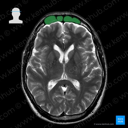 Frontal sinus (Sinus frontalis); Image: 