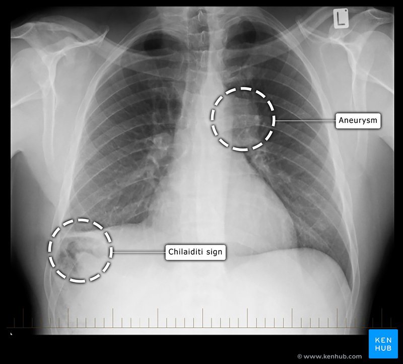 Chest X-ray - aneurysm and Chilaiditi sign