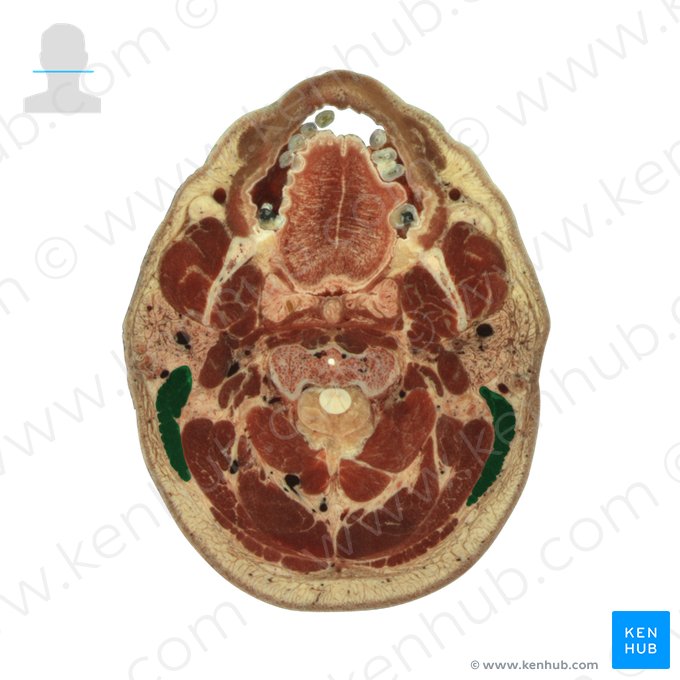 Músculo esternocleidomastóideo (Musculus sternocleidomastoideus); Imagem: National Library of Medicine