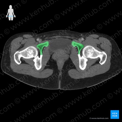 Púbis (Os pubis); Imagem: 