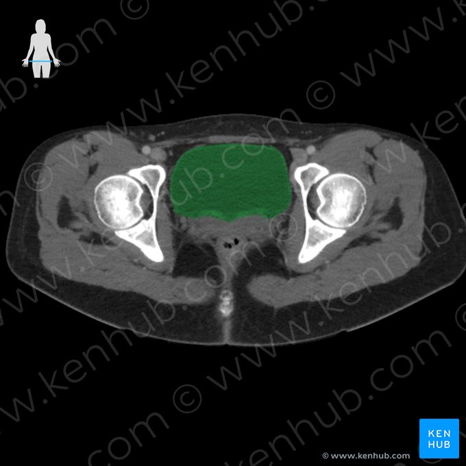 Bexiga (Vesica urinaria); Imagem: 