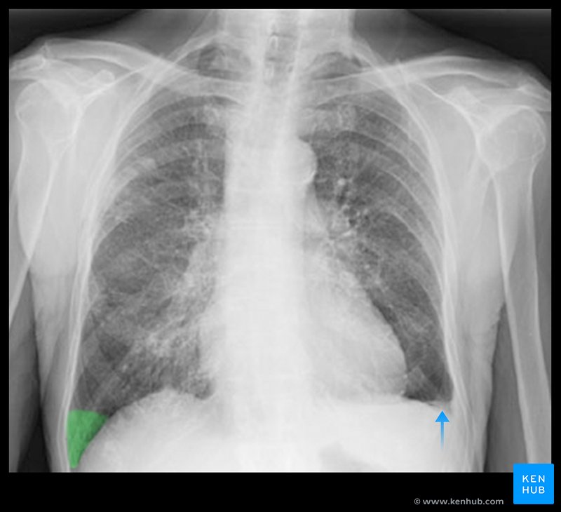 Pleural Effusion