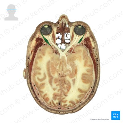 Musculus rectus lateralis (Seitlicher gerader Augenmuskel); Bild: National Library of Medicine