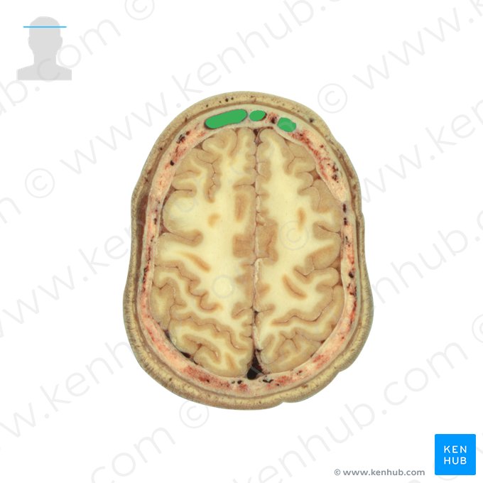 Seio frontal (Sinus frontalis); Imagem: National Library of Medicine