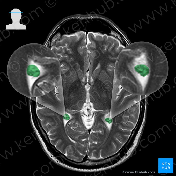 Plexo corióideo do ventrículo lateral (Plexus choroideus ventriculi lateralis); Imagem: 
