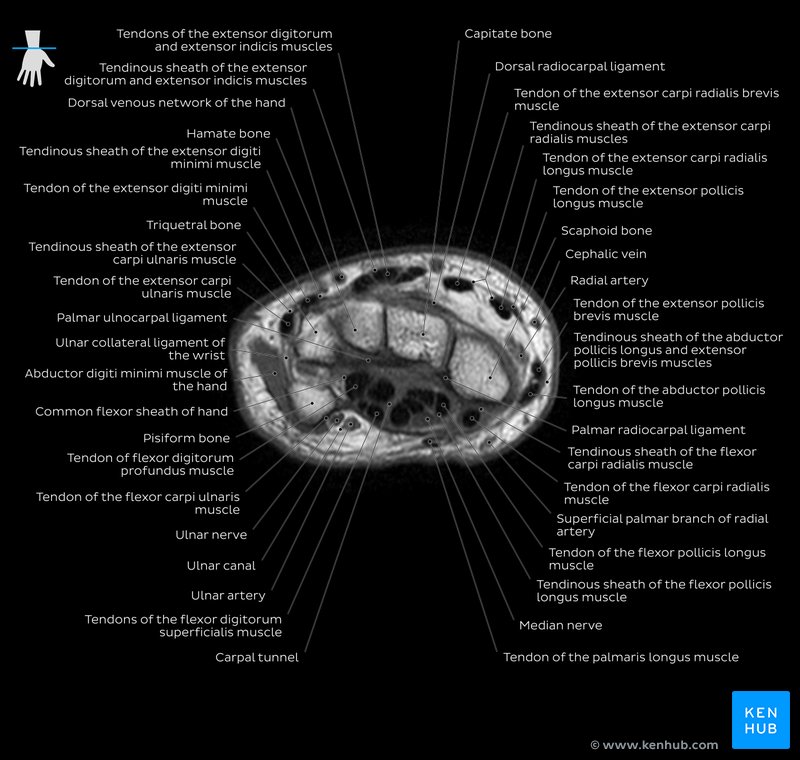 Wrist MRI T1w overview: Carpal tunnel