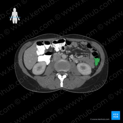 Descending colon (Colon descendens); Image: 