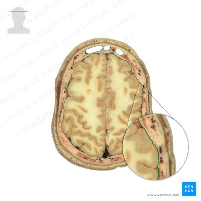 Duramadre (Dura mater); Imagen: National Library of Medicine