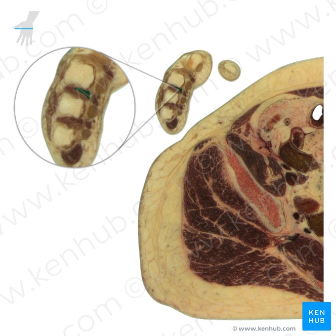 Musculus interosseus palmaris 2 (2. hohlhandseitiger Zwischenknochenmuskel); Bild: National Library of Medicine