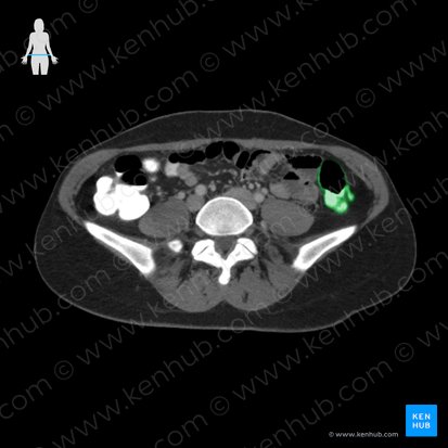 Descending colon (Colon descendens); Image: 