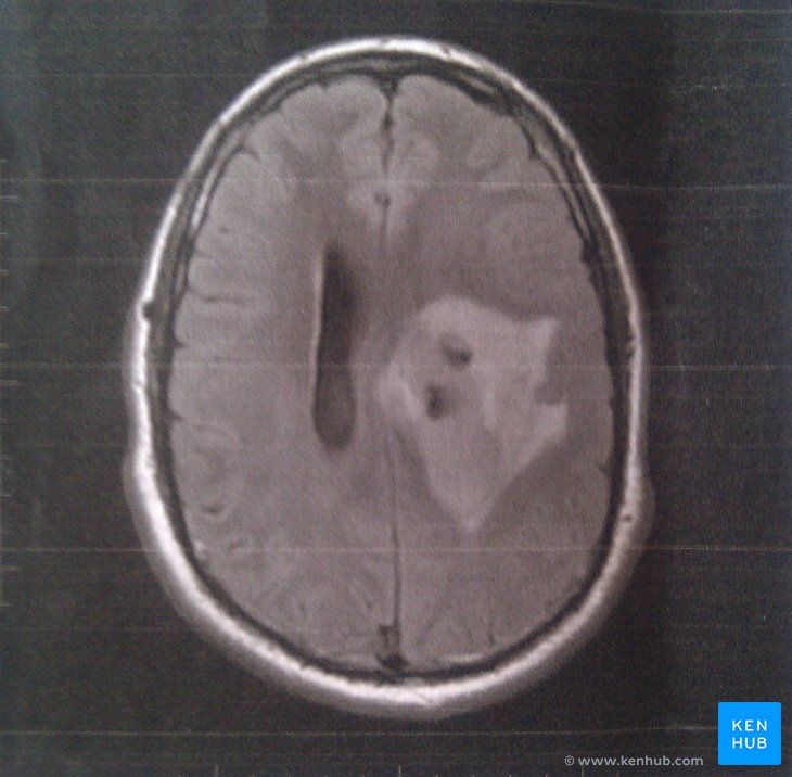 MRI of a brain tumour