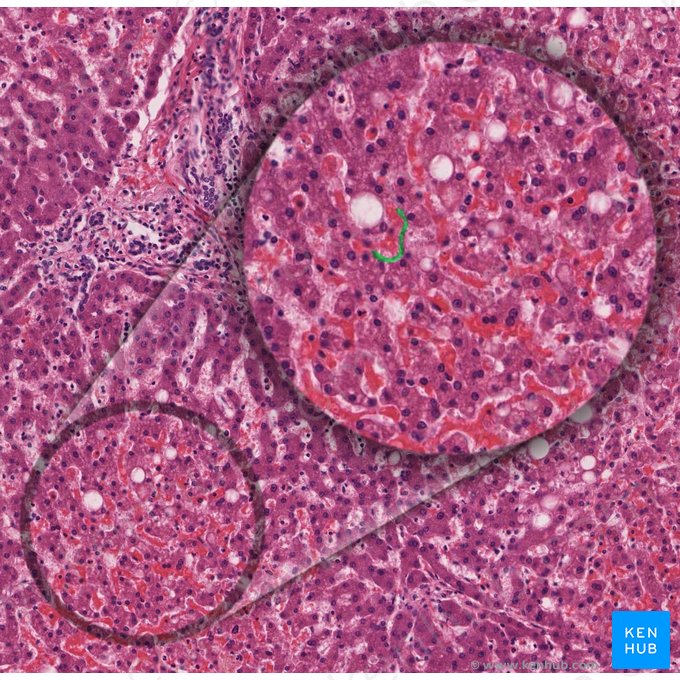 Perisinusoidal space (of Disse) (Spatium perisinusoideum); Image: 