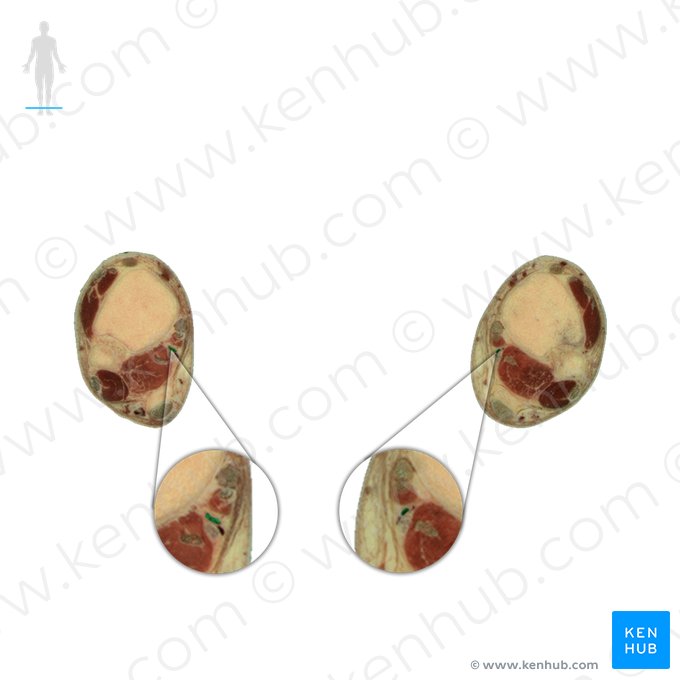 Arteria tibialis posterior (Hintere Schienbeinarterie); Bild: National Library of Medicine