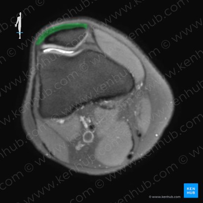 Tendo musculi quadricipitis femoris (Sehne des vierköpfigen Oberschenkelmuskels); Bild: 