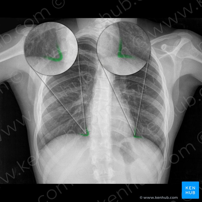 Ângulo cardiofrênico (Angulus cardiophrenicus); Imagem: 