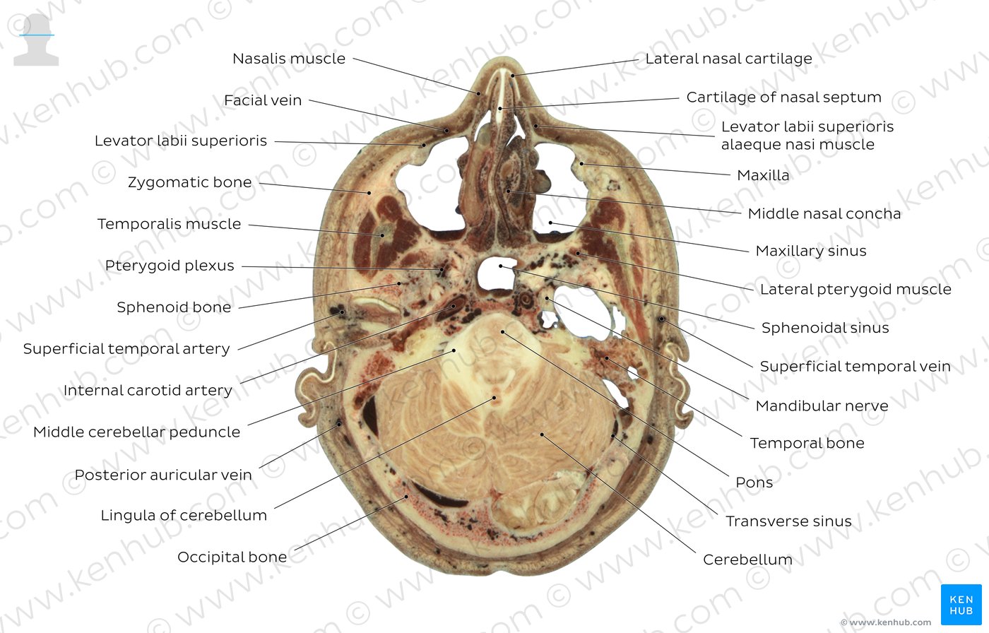 Cross section through the maxillary sinus: Diagram