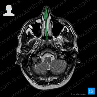 Nasal septum (Septum nasi); Image: 