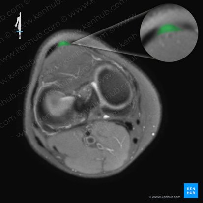 Patella (Kniescheibe); Bild: 